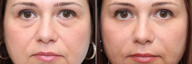 Před a po blefaroplastice - odstranění tukového tělíska pod očima a napnutí kůže