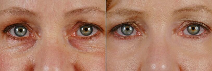 Před a po laserové operaci - omlazení pokožky kolem očí