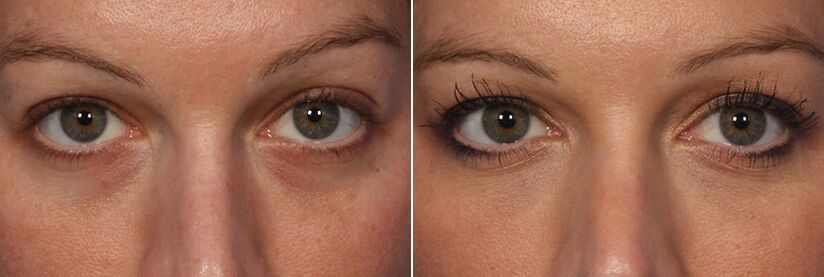 Před a po použití injekčních výplní - redukce kruhů pod očima